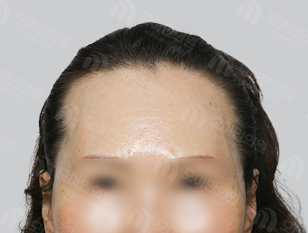 Before 女性症例27 M字ヘアライン