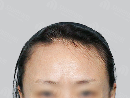 Before 女性症例28 M字ヘアライン