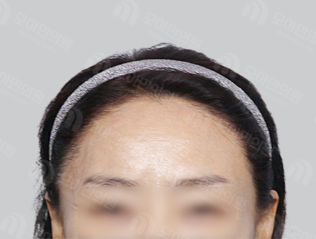After 女性症例28 M字ヘアライン