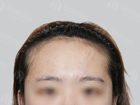 Before 女性症例29 M字ヘアライン