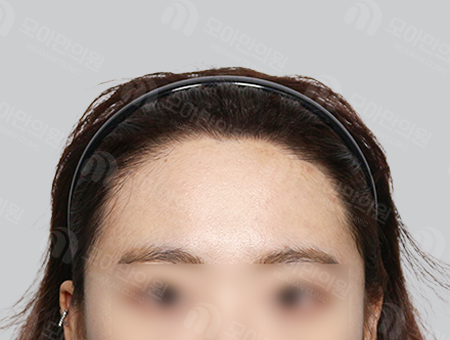After 女性症例29 M字ヘアライン