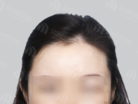 Before 女性症例30 ヘアライン