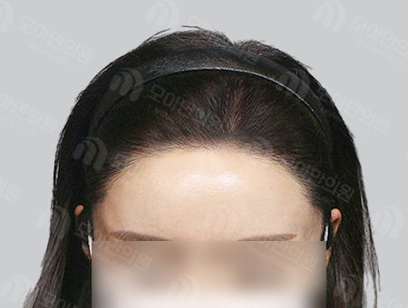 After 女性症例30 ヘアライン