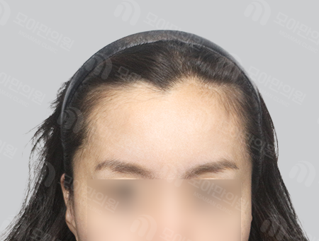 Before 女性症例31 M字ヘアライン