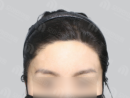 After 女性症例31 M字ヘアライン