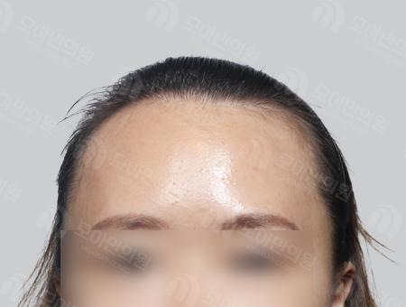 Before 女性症例32 M字ヘアライン