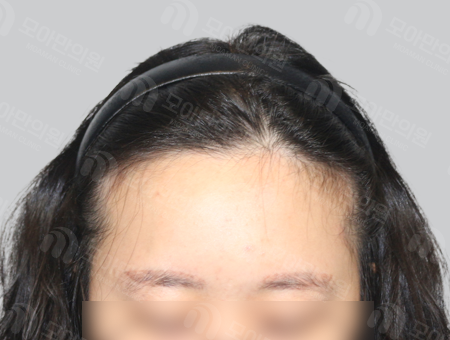 Before 女性症例34 M字ヘアライン