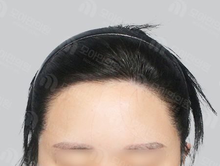 After 女性症例34 M字ヘアライン
