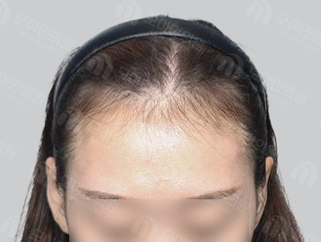 Before 女性症例35 M字ヘアライン