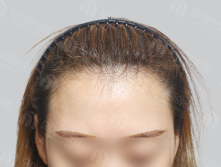 After 女性症例35 M字ヘアライン