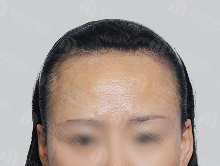 Before 女性症例36 ヘアライン