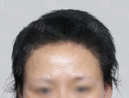 After 女性症例36 ヘアライン