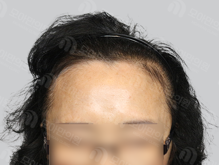 Before 女性症例37 M字ヘアライン