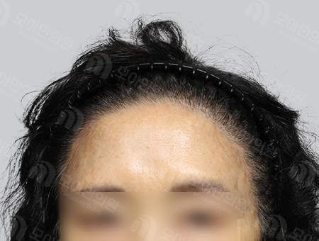 After 女性症例37 M字ヘアライン