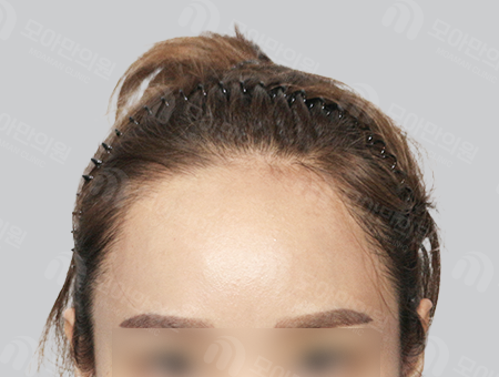 Before 女性症例40 ヘアライン