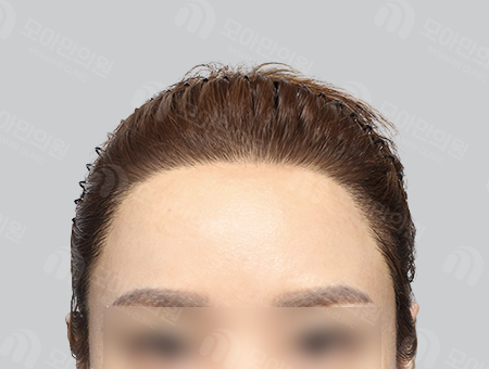 After 女性症例40 ヘアライン