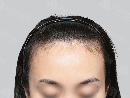 Before 女性症例38 ヘアライン