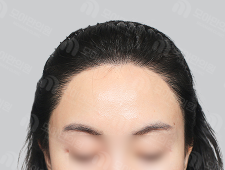 After 女性症例38 ヘアライン