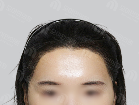 After 女性症例39 ヘアライン
