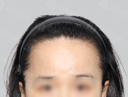 Before 女性症例42 ヘアライン