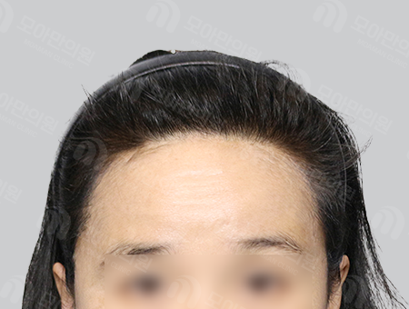 After 女性症例42 ヘアライン
