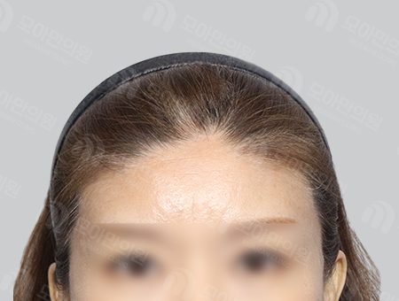 Before 女性症例44 ヘアライン〜分け目
