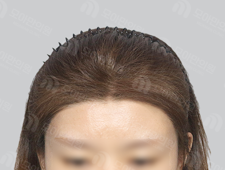 After 女性症例44 ヘアライン〜分け目