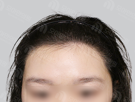 After 女性症例04 ヘアライン