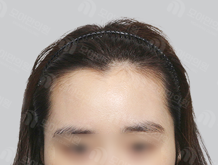 Before 女性症例01 ヘアライン