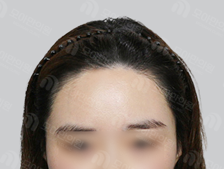 After 女性症例01 ヘアライン