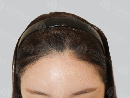 After 女性症例06 ヘアライン