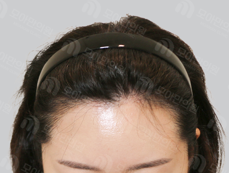 After 女性症例07 ヘアライン