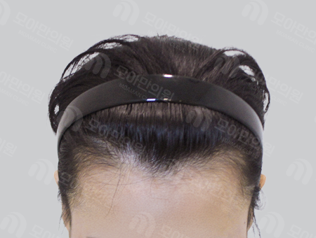 Before 女性症例08 M字ヘアライン