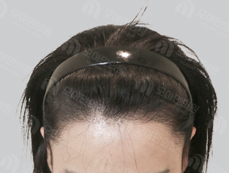After 女性症例08 M字ヘアライン