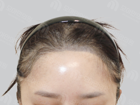 Before 女性症例09 ヘアライン