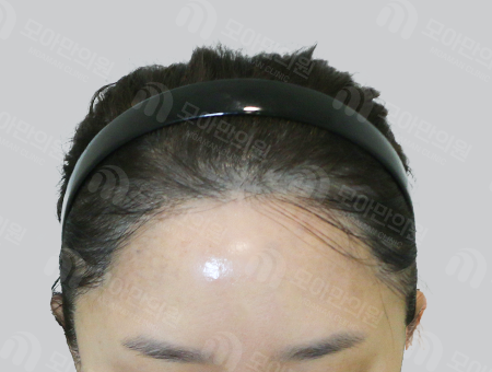 After 女性症例09 ヘアライン