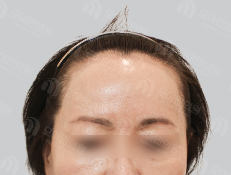 Before 女性症例10 M字ヘアライン