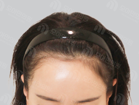 Before 女性症例11 M字ヘアライン