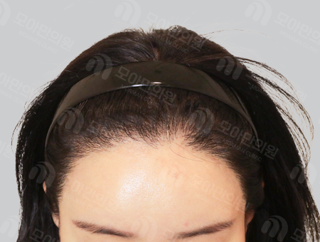 After 女性症例11 M字ヘアライン