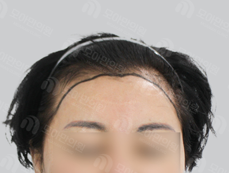 Before 女性症例12 ヘアライン