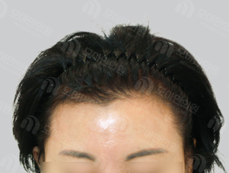 After 女性症例12 ヘアライン