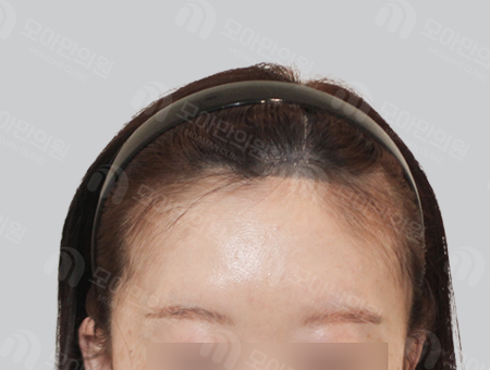 Before 女性症例14 M字ヘアライン〜分け目