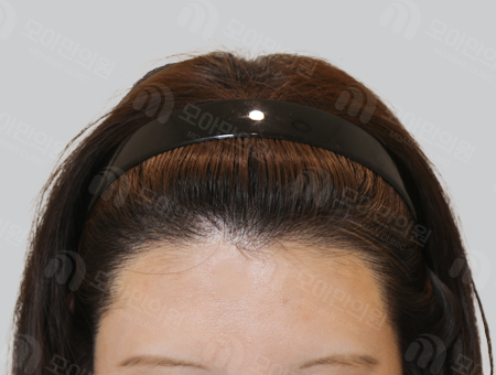 After 女性症例15 ヘアライン