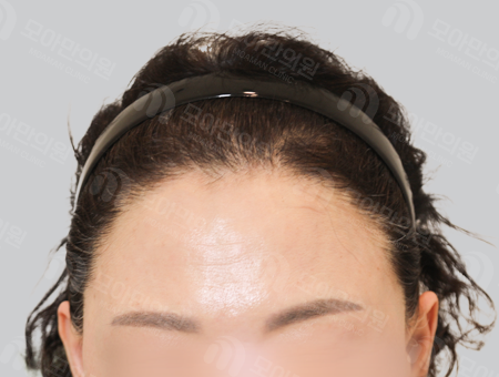 After 女性症例19 M字ヘアライン