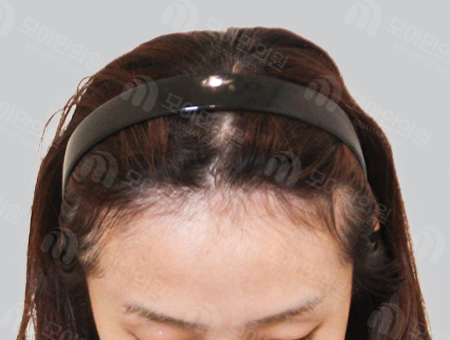 Before 女性症例21 ヘアライン