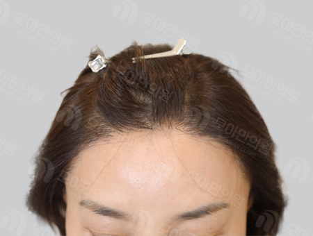 After 女性症例20 ヘアライン〜側頭部