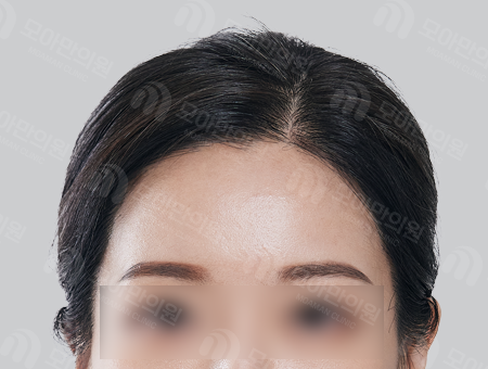 After 女性症例24 ヘアライン