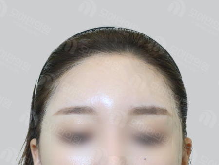 After 女性症例25 ヘアライン