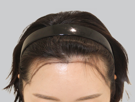 Before 女性症例 ヘアライン 2025