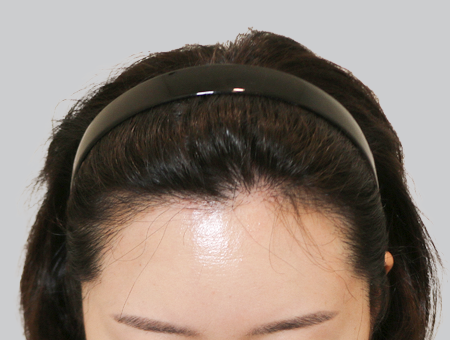 After 女性症例 ヘアライン 2025